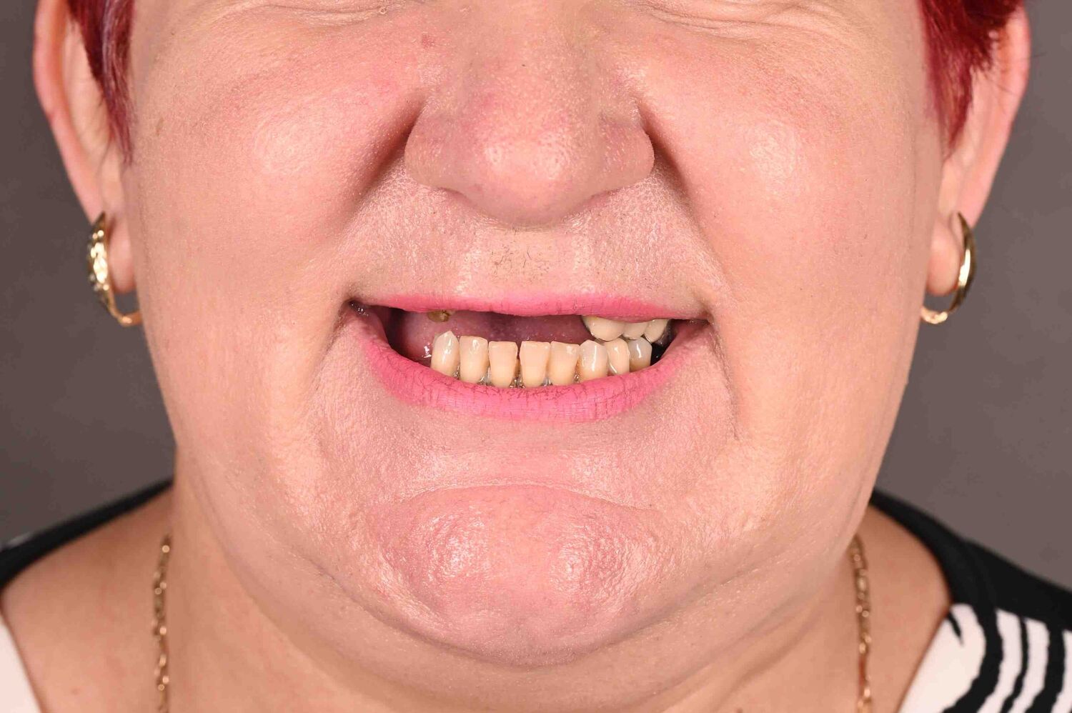 Pacient Clinica Dr. Alin Odor - Rezultat Implantologie